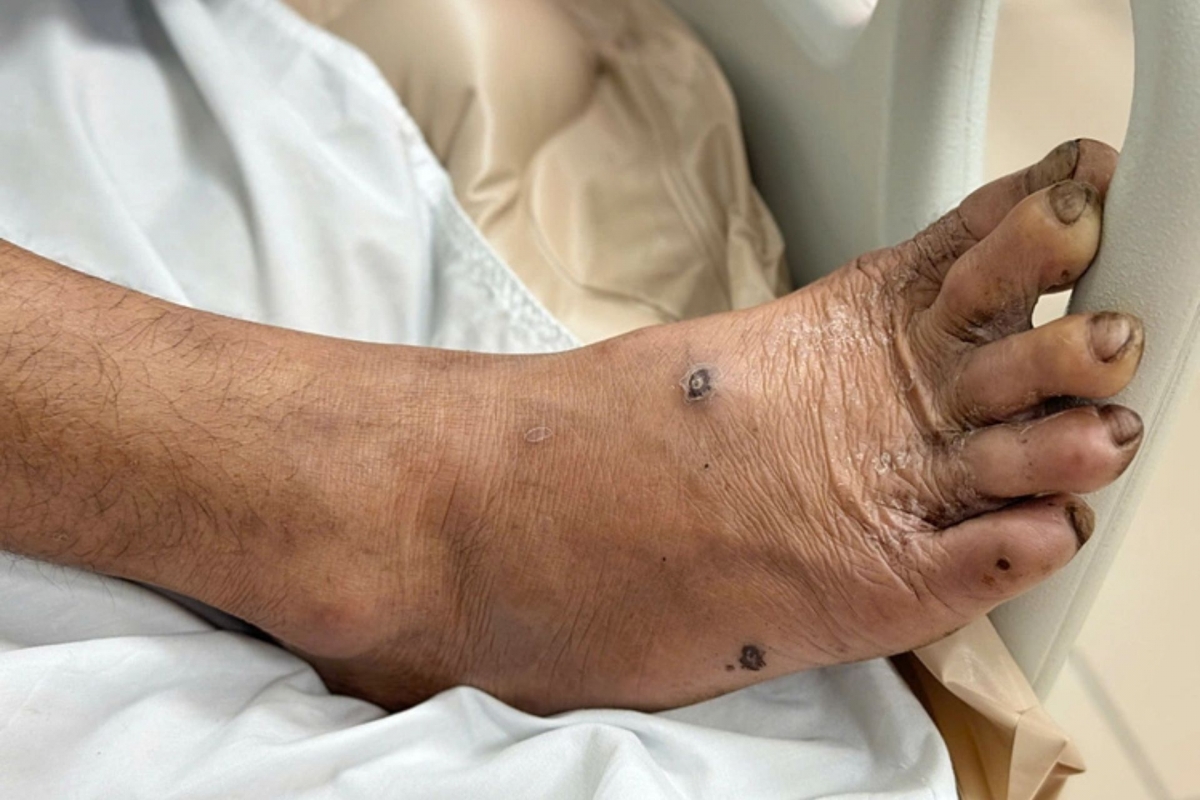 Chủ quan với vết thương nhỏ, nhiều bệnh nhân nhập viện vì uốn ván